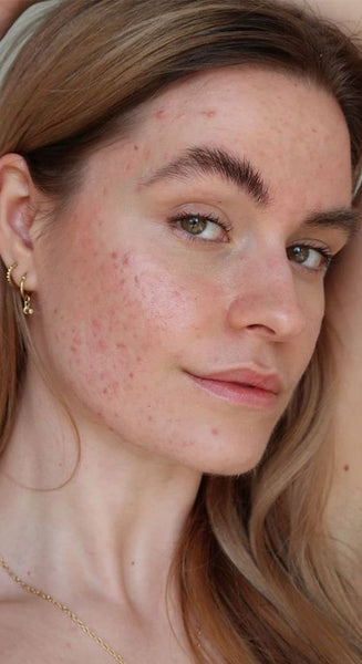 Acne Unmasked: Unveiling the Culprits Behind the Common Skin Conundrum