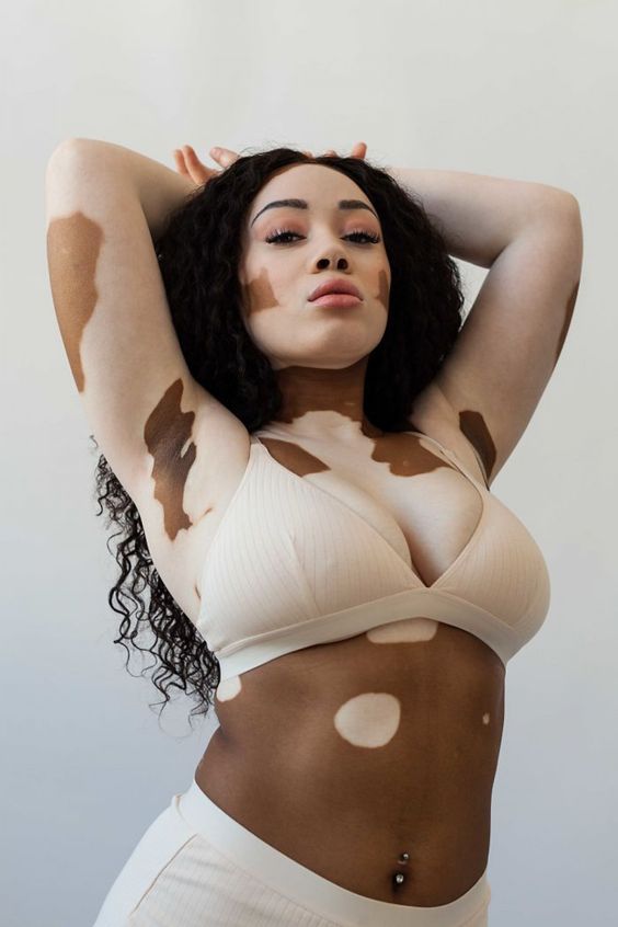 Decoding Vitiligo: Unravelling The Enigma Of A Diverse Canvas
