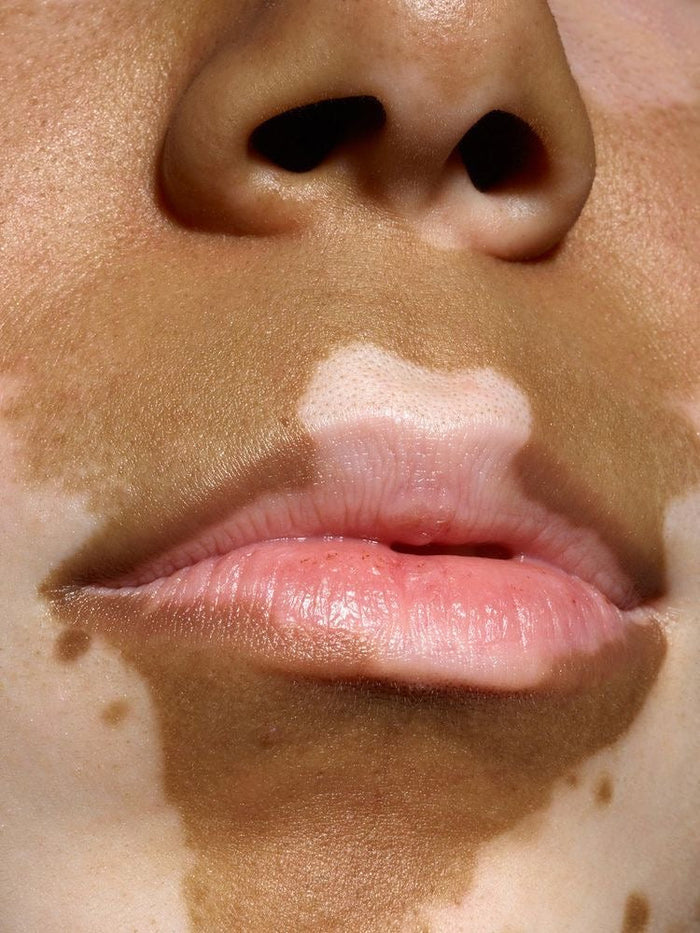 Why Hyperpigmentation Keeps Coming Back, Even After It Fades