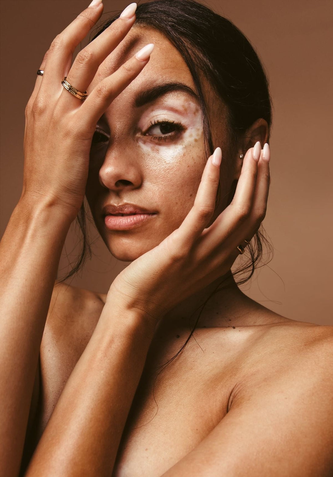 Unravelling the Mystery: Understanding Why Hyperpigmentation Happens