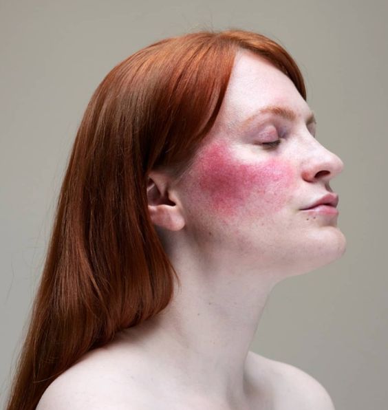 Peering Beneath the Surface: Exploring the Intricate Origins of Blemishes