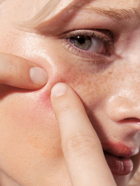Exploring the Various Types of Acne: A Comprehensive Guide to Understanding and Treating Different Forms of Acne