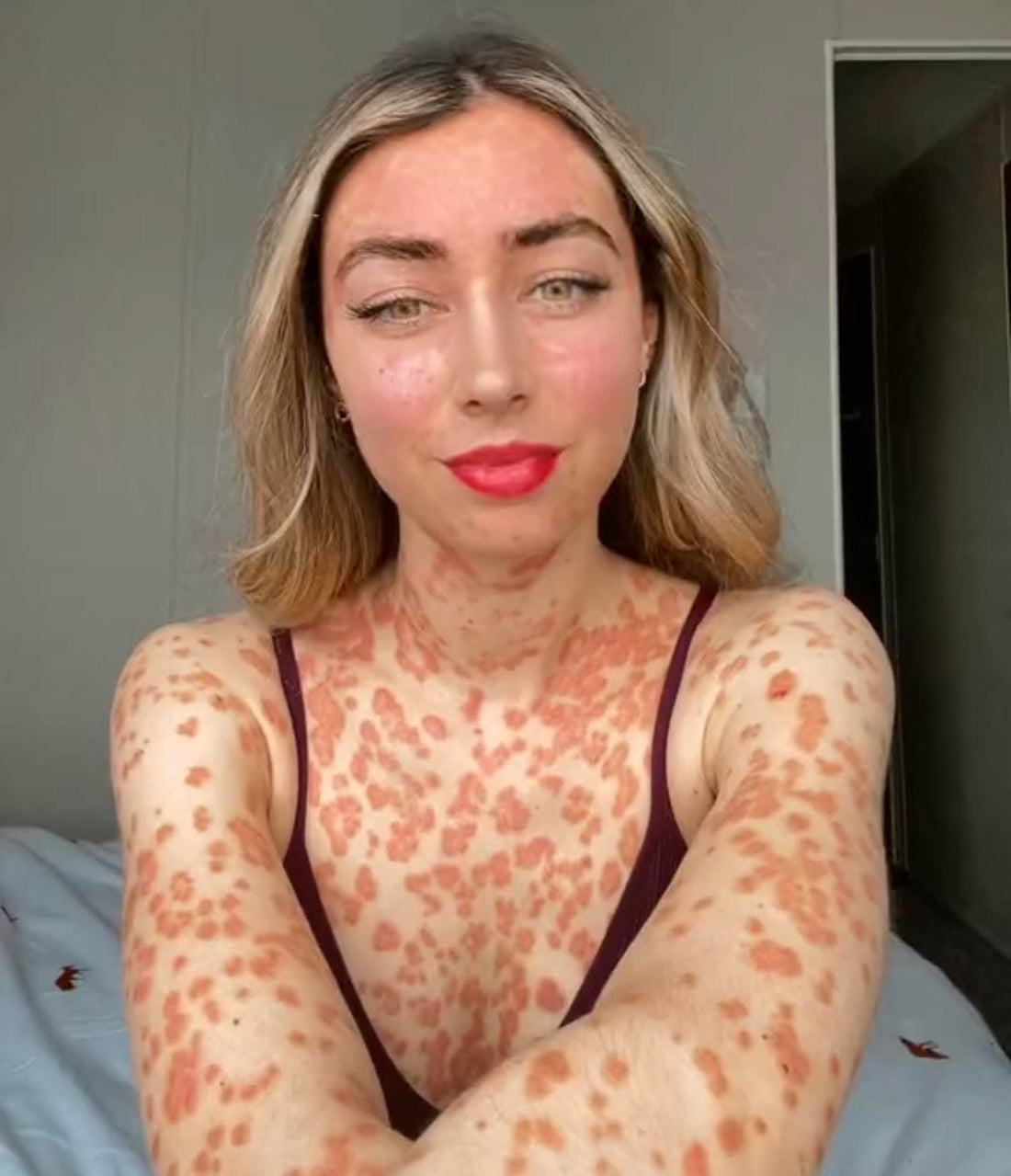 Understanding Psoriasis: the Mystery Behind a Common Skin Condition